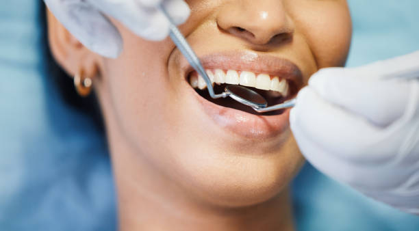 Best Emergency Wisdom Teeth Removal in Nedrow, NY