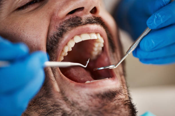 Best Emergency Dental Care for Broken or Chipped Teeth in Nedrow, NY