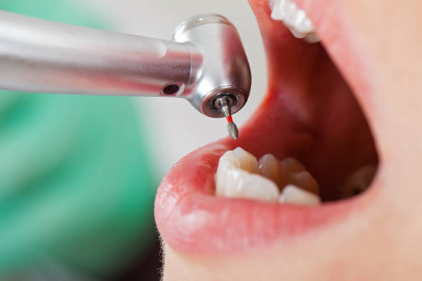 Best Emergency Tooth Extraction in Nedrow, NY
